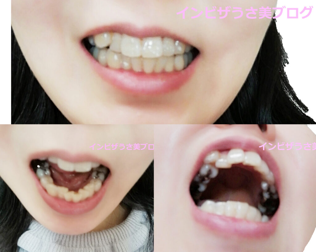 インビザラインを始める前の歯並び Hsp持ち インビザうさ美ブログ